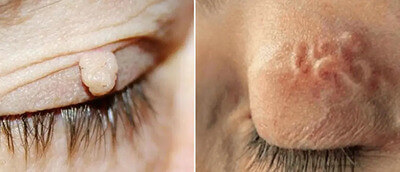 Types of papillomas